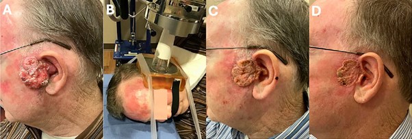 Four images labelled A,B,C and D. (A) The tumour of patient two on the day of MBRT. (B) Treatment photo showing the patient with the collimator holder attached, the 5 cm cone flush and in contact with the tungsten collimator. Tumour response 16 days (C) and 34 days (D) after MBRT.