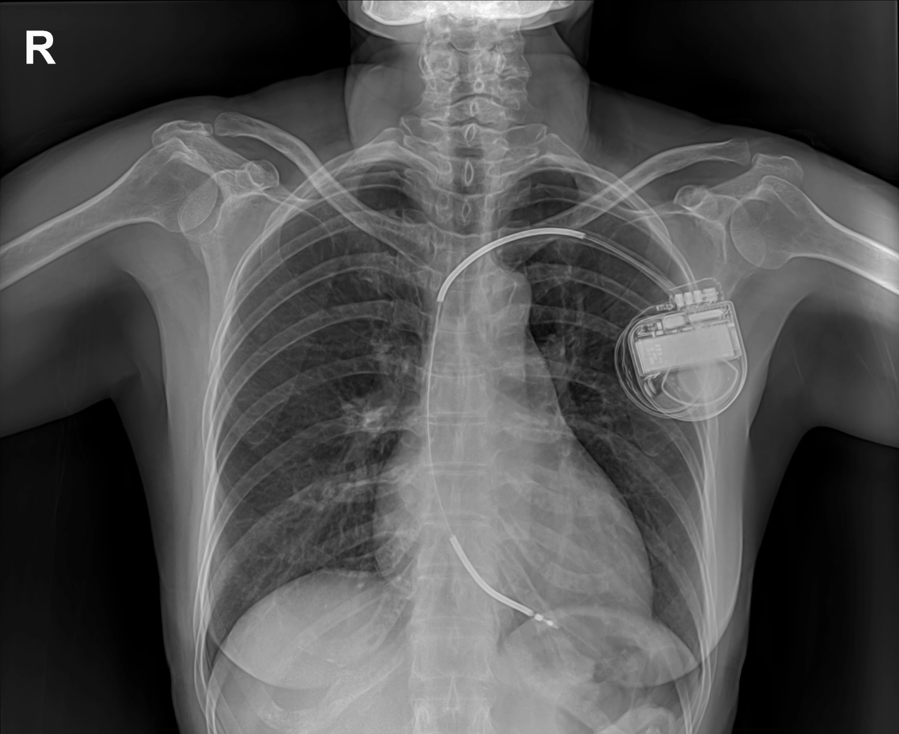 An X-ray of a ribcage fitted with a pacemaker where the heart would be.