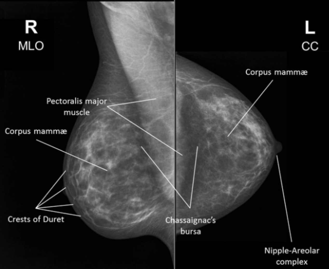 A normal mammogram.