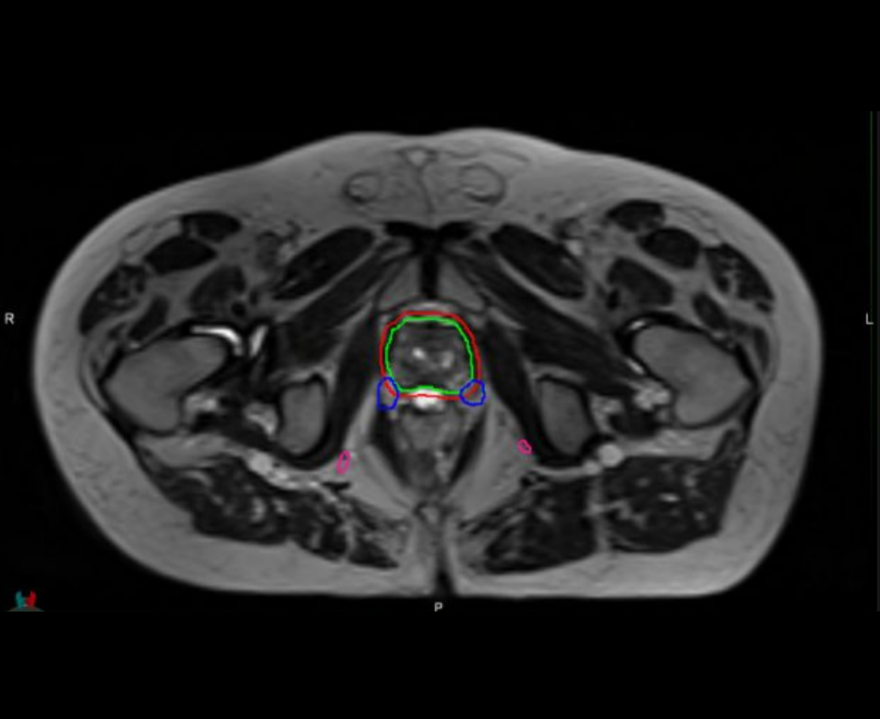 An MRI scan of a prostate.